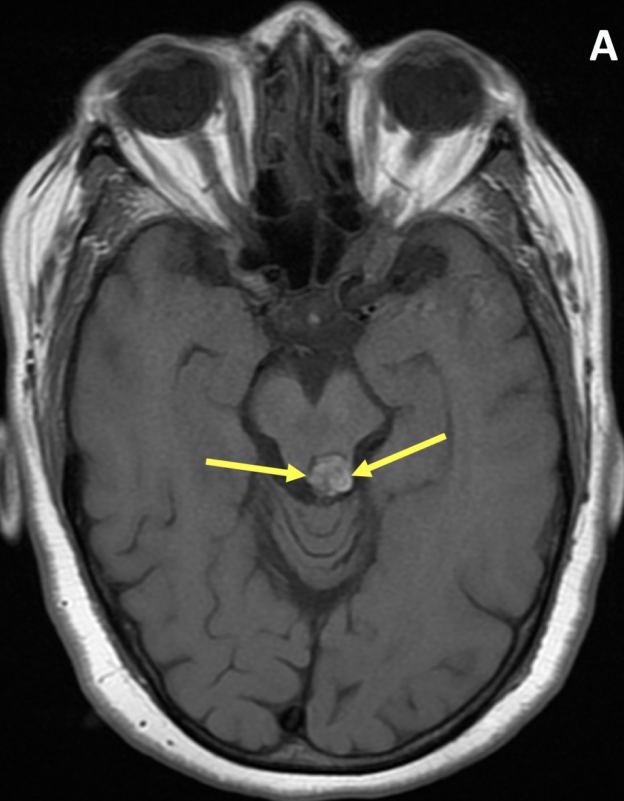 62-year-old man with a cavernous malformation. Axial T1 FSE (A), Axial T2 (B), and Sagittal T1 FLAIR (C) images show a 1.2 cm mass (arrows) with a reticulated pattern of mixed signal intensity (so-called “popcorn” or “mulberry” appearance due to multiple episodes of hemorrhage), with a hypointense rim of hemosiderin. The mass is exophytic and centered slightly to the left of midline at the level of the left superior colliculus of the midbrain extending inferiorly to the superior medullary velum. No acute hemorrhage is identified.