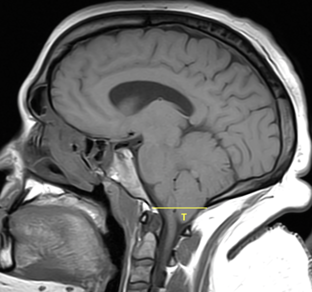 Chiari I malformation in a 29-year-old woman with headaches and neck pain. Sagittal T1 FSE image shows “pegging” of the displaced cerebellar tonsils (T), which extend 8 mm below the foramen magnum (yellow line). No upper cervical syrinx is seen.