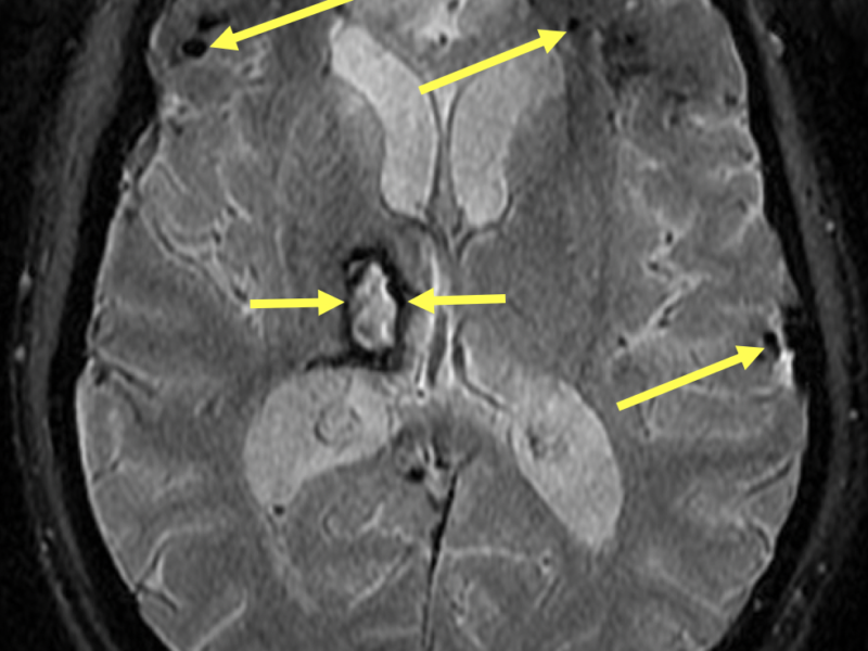 DAI in a 27-year-old man with a history of traumatic brain injury. A. Axial SWI (susceptibility-weighted imaging) shows multiple small ovoid areas of low signal susceptibility artifact from hemorrhage (long arrows) at the gray-white matter junctions in the frontal and temporal lobes, and hemorrhage within the right thalamus (short arrows).