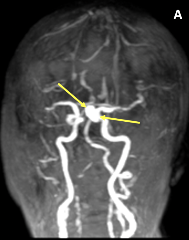 Saccular intracranial aneurysm (IA) in a 71-year-old woman. A. MRA after dynamic contrast administration shows a saccular aneurysm arising from the distal left internal carotid artery (arrows)