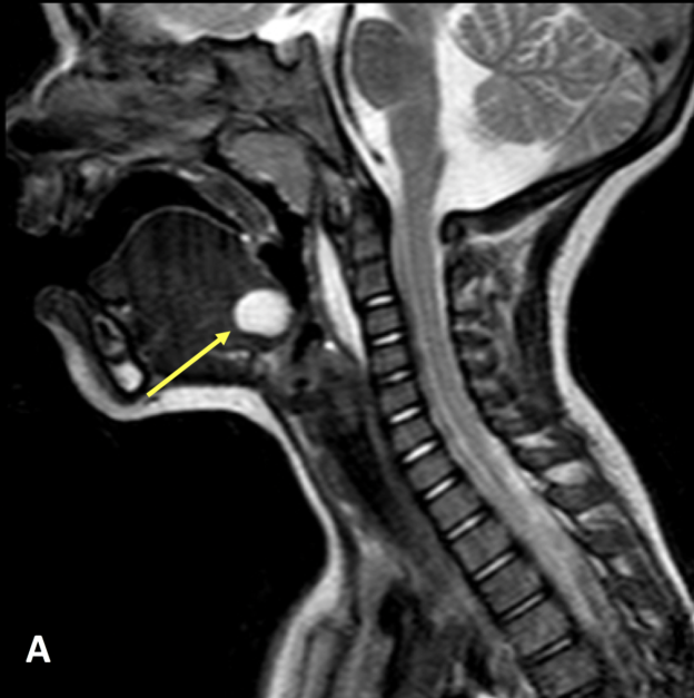 Thyroglossal duct cyst in a 1-year-old boy. A. Sagittal T2 SE midline MR image demonstrates a hyperintense, cystic lesion at the base of the tongue (arrow), which corresponds to the foramen cecum, the embryological origin of the thyroid tissue. Prevertebral high signal is related to a lymphatic malformation.  