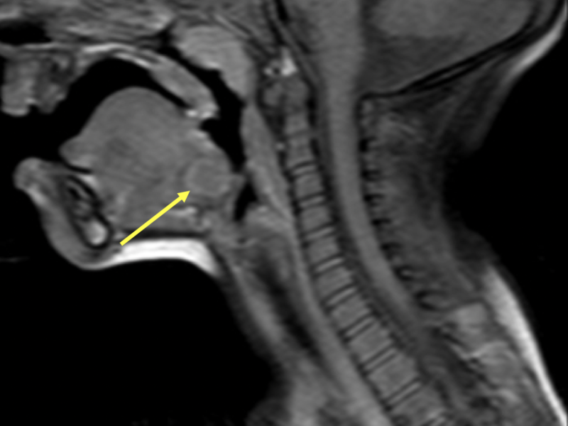 C. Sagittal T1 SE FS post-contrast image at the same level as (A) and (B) confirms the cystic nature of the base-of-tongue lesion (arrow), which does not enhance centrally.   