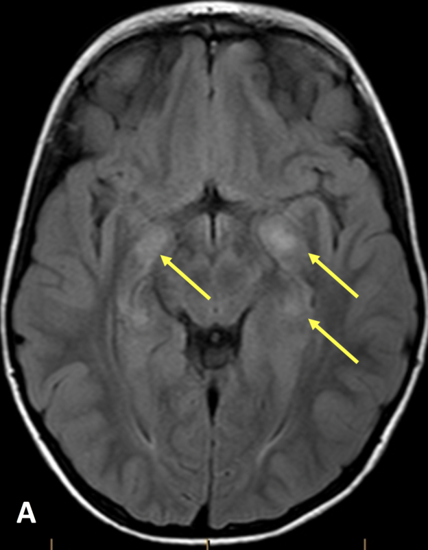 Imaging of multiple children with history of Neurofibromatosis, Type 1 A. Axial T2 FLAIR MR image demonstrates multiple hyperintensities of the unci and periventricular white matter (arrows). There are additional areas of FLAIR hyperintensities involving the basal ganglia (not shown). None of these areas demonstrate enhancement (not shown), compatible with Foci of Abnormal Signal Intensity (FASI) which is due to myelin vacuolization, not masses. These resolve during the second decade of life.