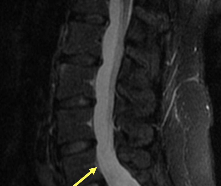 D. Sagittal T2 FS image of the lumbar spine showing outpouching of the thecal sac ventrally (arrows), remodeling the lumbar vertebral bodies and sacrum due to dural ectasia.  