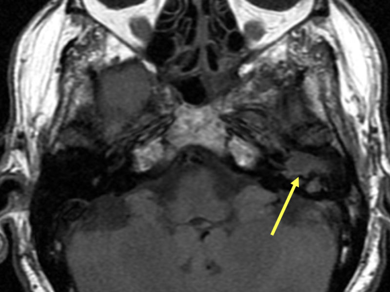 B. Axial T1 SE image shows increased signal in the middle ear (arrow) and mastoid, favoring inflammatory soft tissue, a mass, or cholesteatoma.   