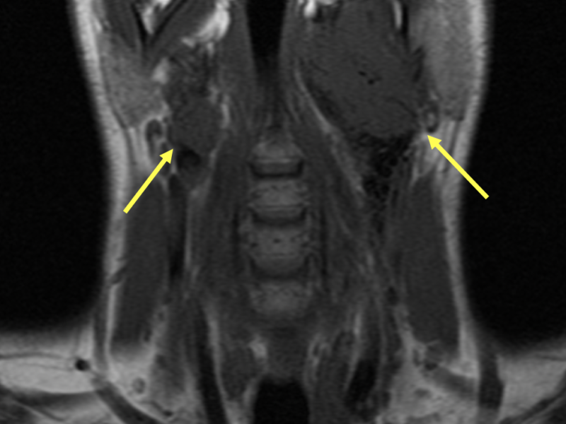 C. Coronal T1 SE image demonstrates the paragangliomas (arrows) and splaying of the right carotid vessels.   