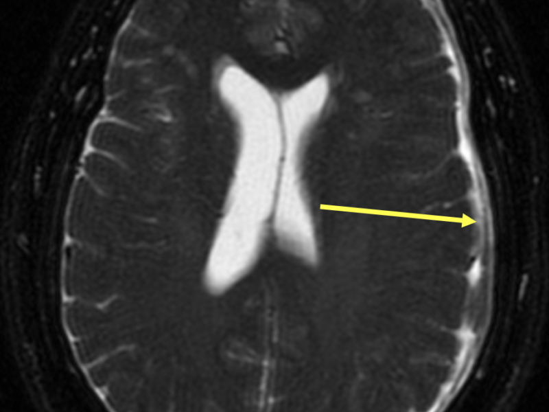 B. Axial T2 FS image at the same level as (A) shows hyperintense signal along the left frontoparietal convexities (arrow), corresponding to subdural hematoma.  