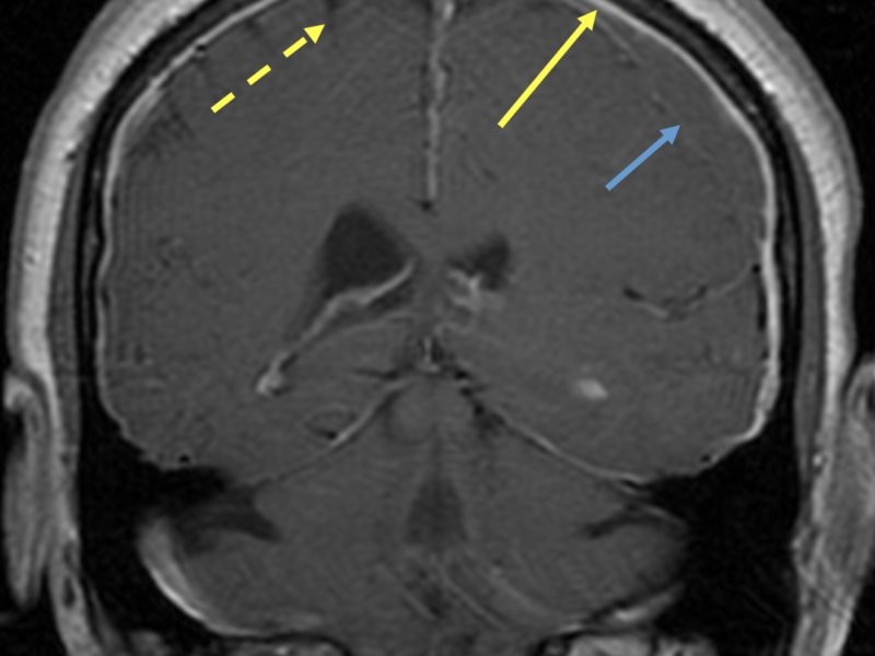 C. Coronal post-contrast T1 image shows diffuse thickening and enhancement of the pachymeninges (solid yellow arrow). Note that it does not follow the sulci (dashed yellow arrow). Left subdural hematoma is again seen (blue arrow)   