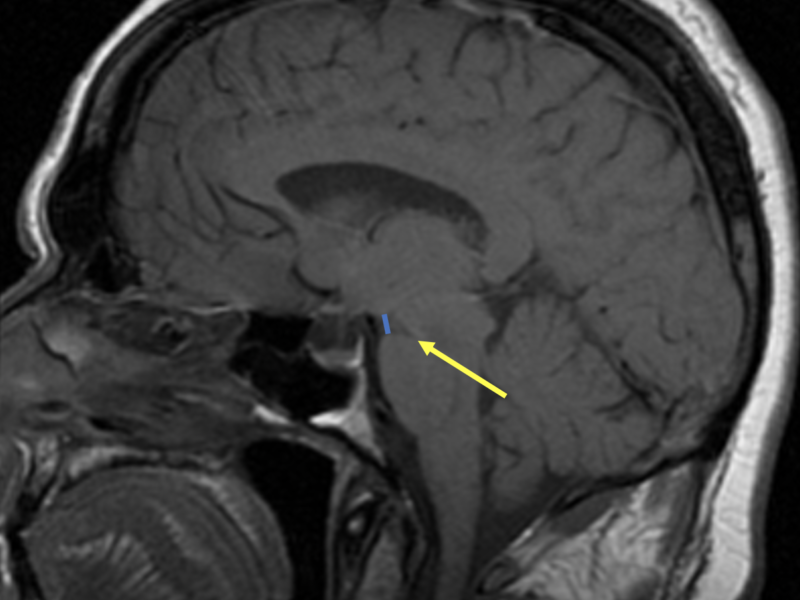 D. Sagittal midline T1 SE image shows decreased pontomesencephalic angle (arrow), measuring less than 50 degrees. There is also decreased mammilopontine distance (line), measuring less than 5.5 mm. These findings are highly sensitive for the diagnosis of intracranial hypotension. Some cases of IH can demonstrate enlargement of the pituitary (not seen in this case).   