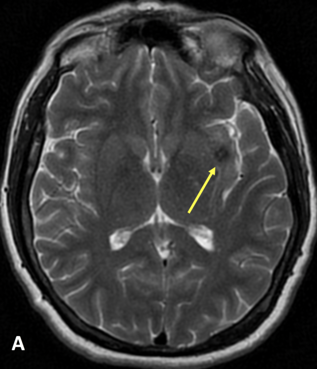 53 year old female with a cavernous malformation, associated developmental venous anomaly, and a 4-day history of dizziness. A. Axial T2 MR image at the level of the basal ganglia shows dark signal in the left insula (arrow), representing susceptibility artifact from blood in a cavernous malformation.  