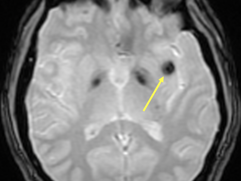 B. Axial GRE image at the same level as (A) confirms T2* dark “blooming artifact” in the left insula, reflecting a cavernous malformation.   