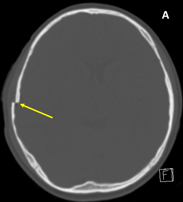 Skull fractures and right-sided bruising in an 8-year-old boy involved in a motor vehicle crash. A. Axial CT with bone windowing shows a depressed right parietal skull fracture with a full calvarial-width’s internal displacement of the anterior fracture fragment (arrow).