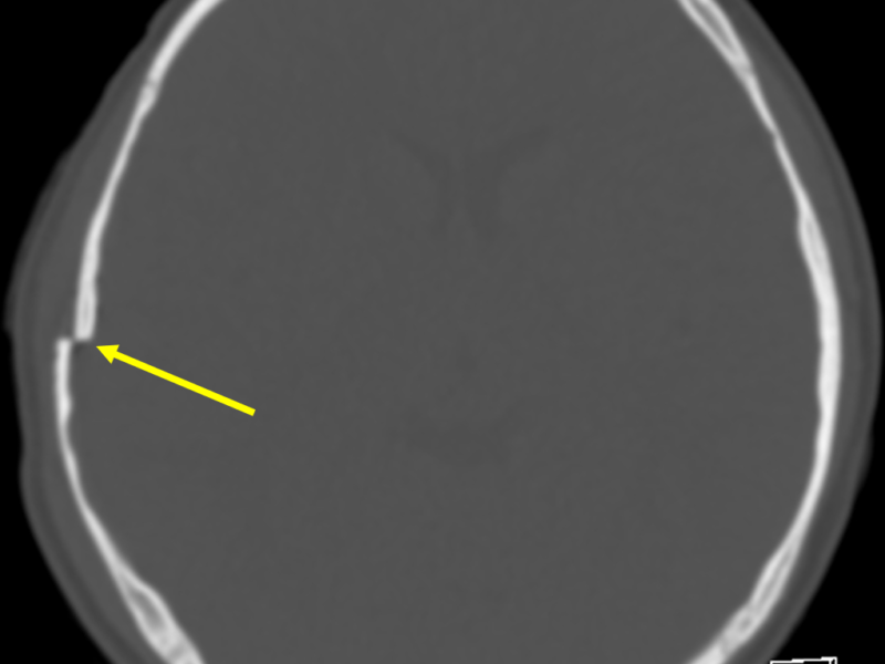 Skull fractures and right-sided bruising in an 8-year-old boy involved in a motor vehicle crash. A. Axial CT with bone windowing shows a depressed right parietal skull fracture with a full calvarial-width’s internal displacement of the anterior fracture fragment (arrow).