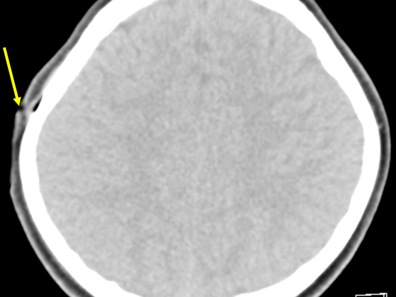 B. Axial CT at a level superior to (A) with soft tissue windowing shows a right scalp injury (arrow).