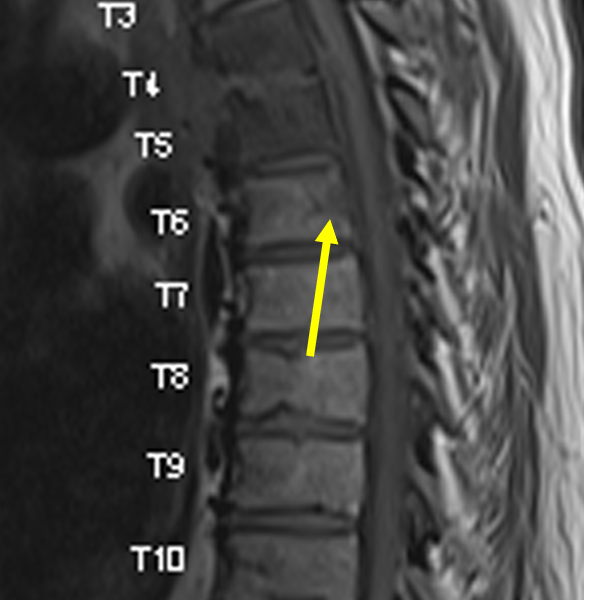 Spinal epidural abscess in a 57-year-old man with back pain and bacteremia. A. Sagittal T1 TSE MR image shows abnormal low signal within the T4 and T5 vertebral bodies and the T4-5 disc space, as well as destructive end plate changes at T4 and T5, consistent with vertebral discitis-osteomyelitis. There is also an area of low signal within the posterior aspect of T6 (arrow).