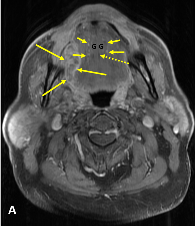 Squamous cell carcinoma of the right tongue in a 62-year-old man. A. Axial T1 FSE fat saturated MR image with contrast shows a 4.3 cm heterogeneously enhancing mass (solid long arrows) in the right lateral tongue and floor of the mouth. The mass does not cross the midline. The hypointense fatty lingual septum (dashed arrow), marking the midline floor of the mouth, is intact. Paired genioglossus (G) muscles are lateral to the septum. The sublingual space containing the neurovascular bundles (solid short arrows) is lateral to the genioglossus mm.