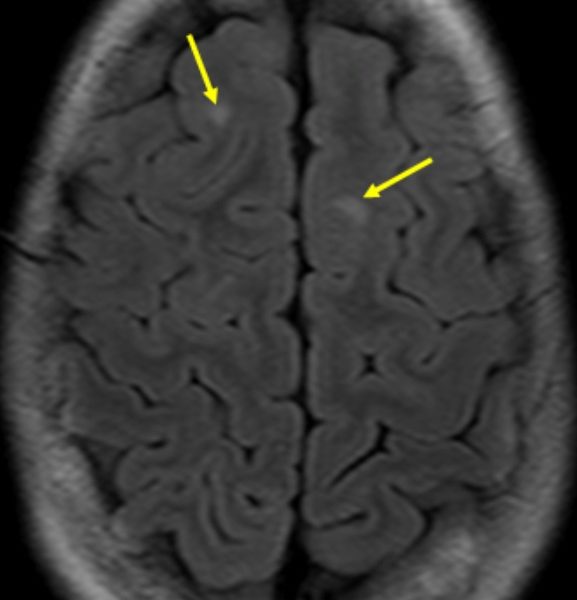 C: Axial T2 FLAIR image shows multiple high signal cortical and subcortical foci consistent with TSC tubers (arrows).