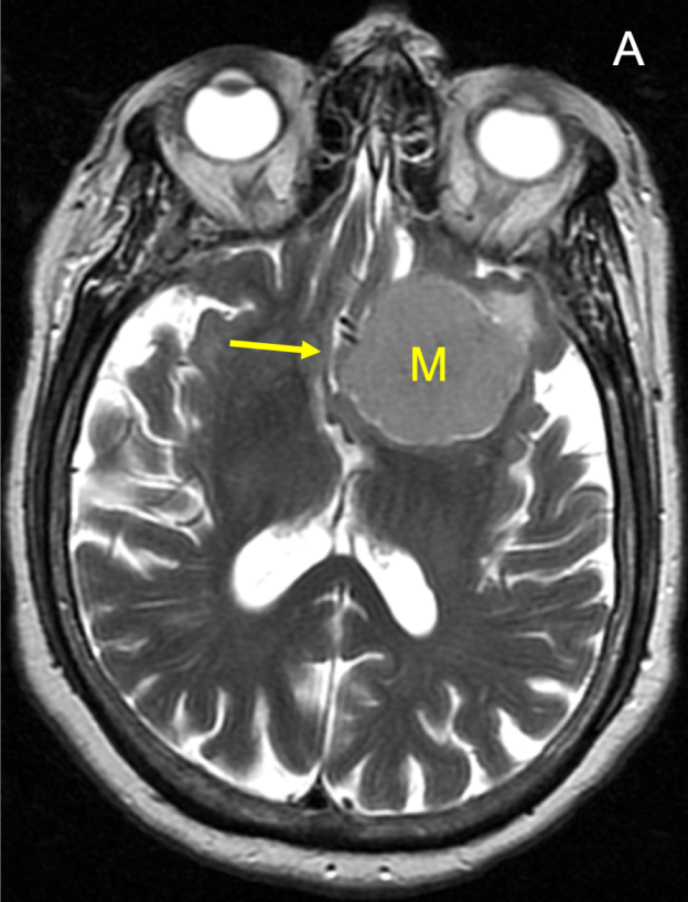 Left anterior and middle cranial fossa meningioma in a 85-year-old woman with memory loss. A: Axial T2-weighted image at the level of the lateral ventricles shows a well-demarcated, homogeneous mass (M), hyperintense to brain, that effaces the lateral ventricles and causes mild righward subfalcine herniation (arrow). B: Axial T2 image inferior to (A) shows encasement of the left cerebral vasculature (arrow). C and D: Coronaal T2 images show effacement of the frontal horn of the left lateral ventricle (FH) and encasement of the left anterior and middle cerebral anteries (arrows). There is also nonspecific cerebral volume loss.