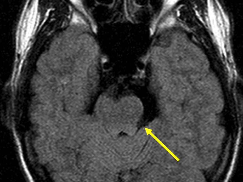 B. Axial T2 FLAIR image at the same level as (A) shows incomplete CSF signal suppression in the area of the epidermoid cyst (arrow). 