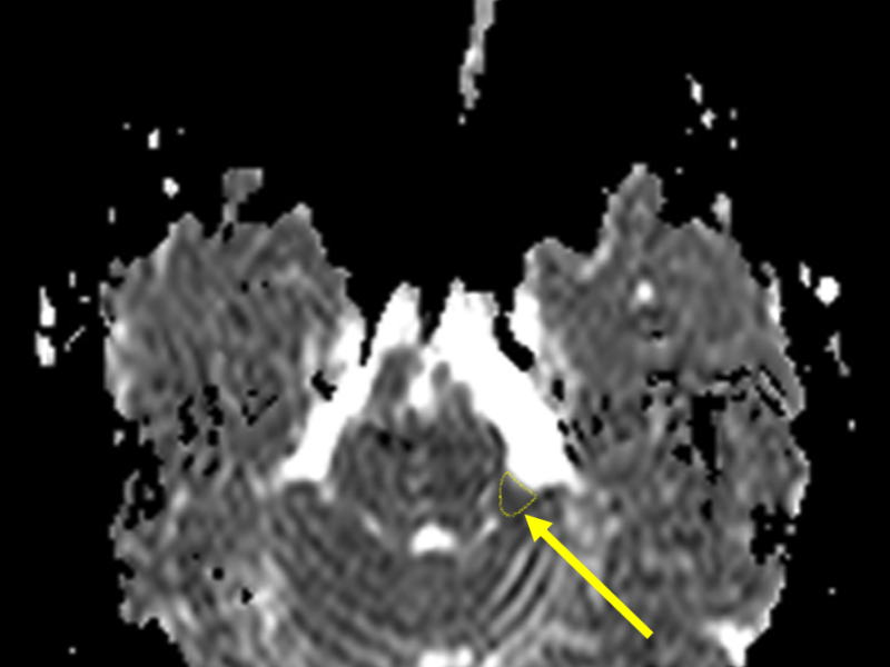 D. The ADC map confirms restricted diffusion, representing residual epidermoid cyst (arrow and outline).