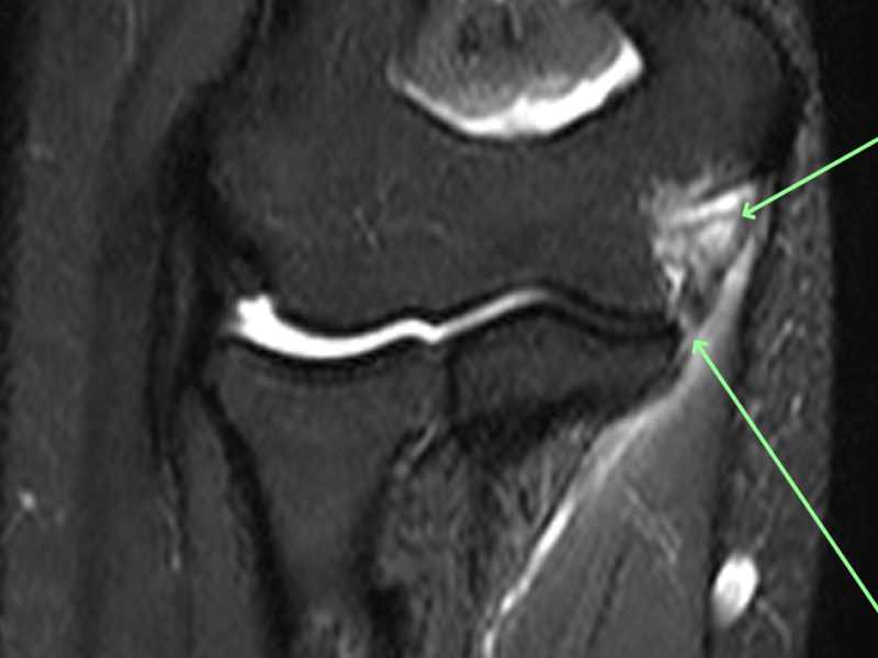 Torn Ulnar Collateral Ligament Elbow