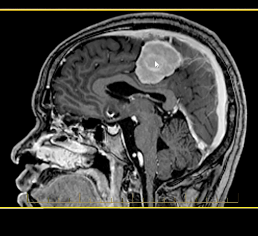 mri mastery series brain tumors