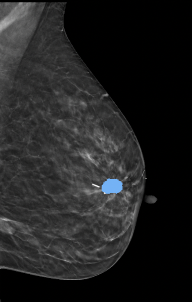 AI Breast Mammography