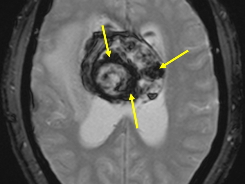 C. Axial T2 gradient echo image at the same level as (A) shows extensive low signal “blooming” artifact (arrows) throughout the mass, representing hemorrhage.